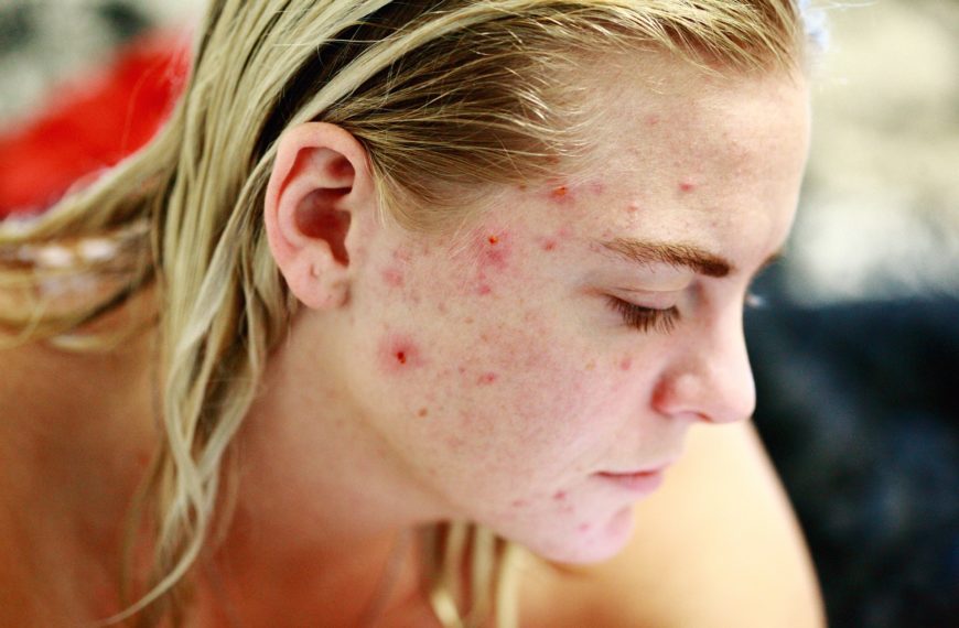 The Link Between Diet and Acne: Foods to Avoid and Foods to Eat